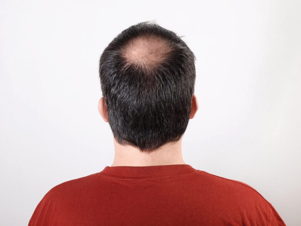 Haarausfall , was wirklich hilft. Mann mit schütterem Haar oder Alopezie oder Haarausfall