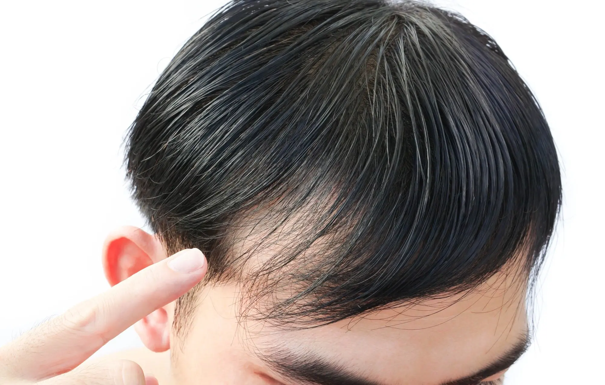Hair loss - effluvium or alopecia?