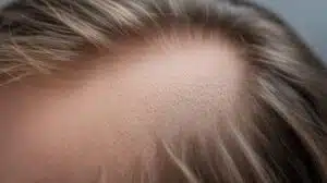 Verständnis von Alopezie-Symptomen und -Arten