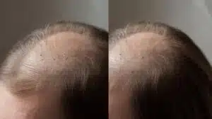 Haarausfall Ursachen und Lösungen