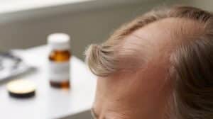 Upadacitinib fördert das Haarwachstum